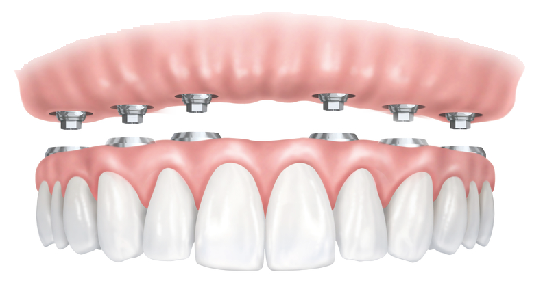 proteza capse pe implant dentar