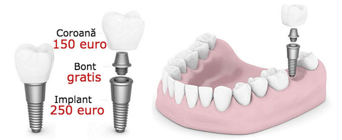 implant dentar pret Bucuresti